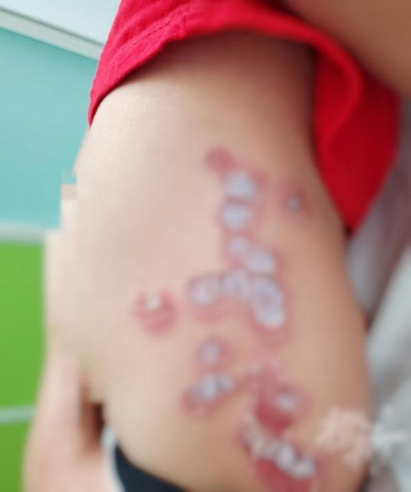 Skin ulceration! It's contagious once it's touched? Parents: I just went to ...